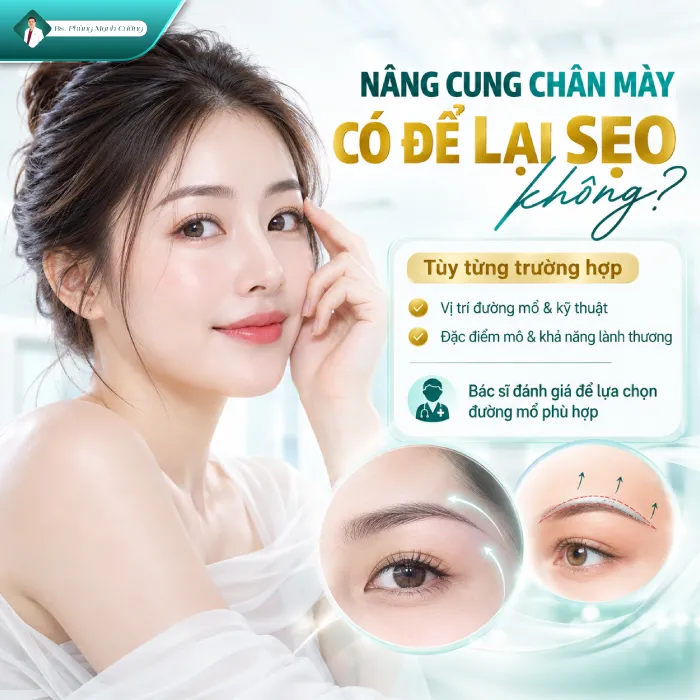 Nâng Cung Chân Mày Có Để Lại Sẹo Không? Giải Đáp Từ Góc Nhìn Chuyên Môn