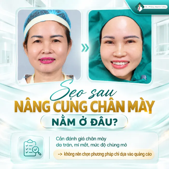 Nâng Cung Chân Mày Có Để Lại Sẹo Không? Giải Đáp Từ Góc Nhìn Chuyên Môn